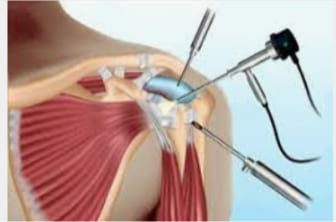 Artroscopia de hombro